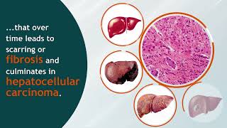 Pathogenesis of Hepatitis [upl. by Nyladnewg]