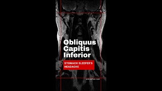 Obliquus Capitis Inferior Muscles and Stomach Sleepers Headache [upl. by Neidhardt]