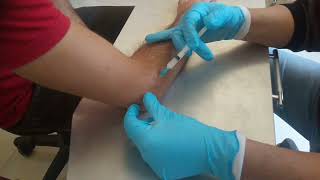 مرفقُ التِّنسِ العلاجُ بحقنِ الكورتيزون Tennis Elbow Cortisone Injection [upl. by Marianne]