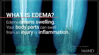 What is Edema  WebMD [upl. by Davis600]