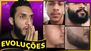 EVOLUÇÕES COM MINOXIDIL resultados dos inscritos 120 [upl. by Leibrag563]