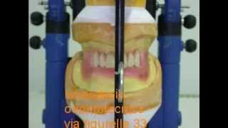 riabilitazione denti con protesi totale 2 [upl. by Richel]