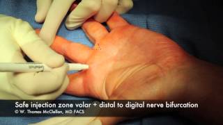 Live Surgery Digital Block Anesthesia of the Finger [upl. by Lowenstein]