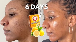 Mix Baking Soda and Lemon Juice 6 DAYS CLEAR SKIN HACK [upl. by Rask505]