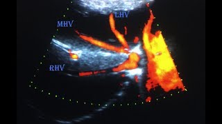 Ultrasonography TutorialSonographic Anatomy of The Liver [upl. by Ilatfan226]