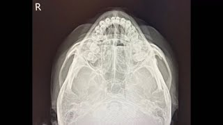 Zygomatic arch Xray position and image 광대뼈 방사선 포지션 Posición e imagen de rayos X del arco cigomático [upl. by Vernice]