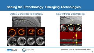 Dr Rushi Parikh quotImproving outcomes following hospitalization for heart failure what’s newquot [upl. by Ytinirt]