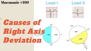 Causes of Right Axis Deviation ECG Mnemonic by MedSurvival [upl. by Yrag]