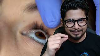 Glaucoma symptoms and treatment in Hindi  Galucoma kya hai glaucoma ka lakshan kya hai [upl. by Eimma]