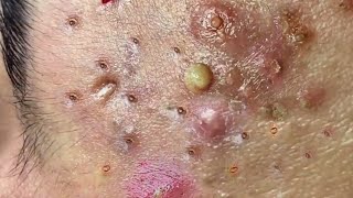 Blackhead Removal With Sac Dep Spa 110107 [upl. by Deegan]