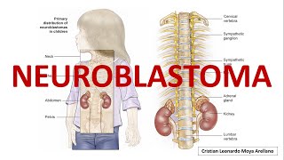 🔴 NEUROBLASTOMA [upl. by Walker]