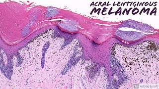 Acral Lentiginous Melanoma Dermatopathology [upl. by Notnirb]