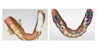 Virtual Mount  A New Digital Technique for Occlusal Examination [upl. by Bertold112]