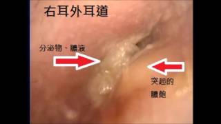 外耳道膿皰 right ear canal carbuncle Dr KenLiao Liu [upl. by Ikiv519]