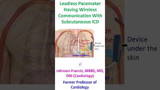 Leadless pacemaker having wireless communication with subcutaneous ICD [upl. by Yentiw]