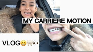 MY CARRIERE MOTION APPLIANCE  VLOG [upl. by Darlene]