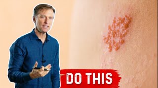 How to Deal With Ringworm Naturally [upl. by Bannon]