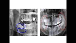 Dentigerous cyst [upl. by Toll134]