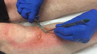 Burns Blister Debridement 2 [upl. by Melony794]