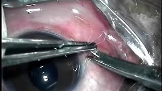 Scleral fixation suture IOL implantation [upl. by Forlini254]