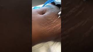 Stretch Marks Inkless Removal Boleyn Treatment Los Angeles 🌍 shorts [upl. by Lehsar350]