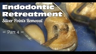 Endodontic Retreatment  Silver Points Removal Part 4 [upl. by Enaira698]