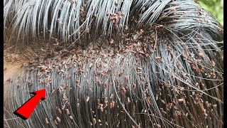 Long Hair Extremely damage  Big Lice Removal [upl. by Zelle]