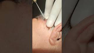 Electrocoagulation of Soft Fibroma on the Scalp [upl. by Droffig]