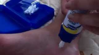 Dr Scholls Dual Action Freeze away wart remover how to for large warts [upl. by Enileme674]