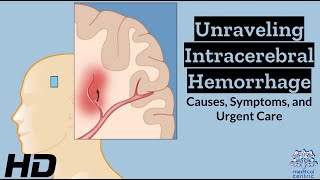 Intracerebral Hemorrhage Unveiled Understanding the Whys Whats and Hows [upl. by Adieno409]