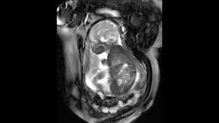 MRI Fetus 37 weeks [upl. by Rutledge]