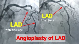 Angioplasty ll Angioplasty procedureRadial access Stenting of LAD हार्ट मैं छल्ला कैसे लगाते है [upl. by Imak718]