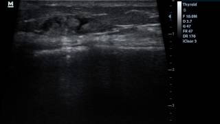 US guided block of the Infrapatellar branch of the Saphenous nerve [upl. by Ahseal708]