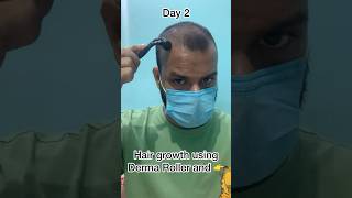 Opening small pores using Derma Roller  Hair Growth dermaroller hairgrowth [upl. by Xever]