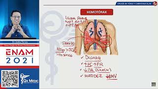 TRAUMA TORACICO EN CIRUGÍA DE TÓRAX Y CARDIOVASCULAR  Hemotórax Masivo [upl. by Oiludbo604]