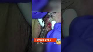 Pimple eyes REMOVAL [upl. by Chan]