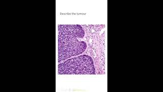 Exam slidesepithelial lesions 2 Dr GSS SRM MCH RC [upl. by Leber260]