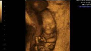 12 week ultrasound 3D4D baby [upl. by Llenwad]