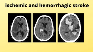 ischemic and hemorrhagic stroke [upl. by Janey]