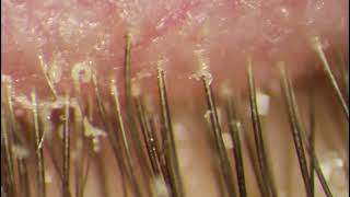 Demodex Eye Infection  Extraction of Mite Placed on Eyelid [upl. by Levon672]