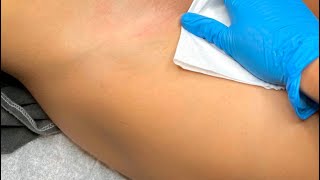 Brazilian waxing hard waxing step by step brazilianwaxing waxing wax [upl. by Swamy]