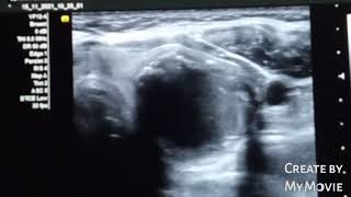 TIRAD 5 thyroid nodule  suspicious  ultrasound case [upl. by Ardnassac544]