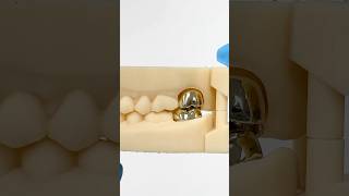 Opposing Gold Crowns EnvisiontecMain envisiontec lsk121shorts dentist [upl. by Selie827]