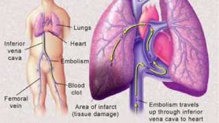 Pulmonary Embolism [upl. by Eirroc]