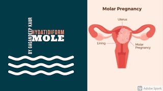 HYDATIDIFORM MOLE Unit7 OBG HIGH RISK PREGNANCY [upl. by Samy]