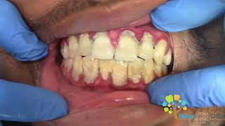 Dental Cleaning to remove heavy tartar🦷 【Young Male first cleaning】 [upl. by Anoval]