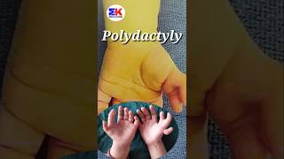 Polydactyly  What is Polydactyly shorts MedicineKnowledgehindi [upl. by Ella]