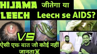 Hijama Therapy Vs Leech Therapy  कौन न है सबका बाप कौन है सबसे ज्यादा effective [upl. by Samford]