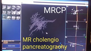 MRCP how to do MRCP in Hindi language MRI magnetic resonance colongio cinematography [upl. by Quintilla]