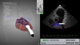 HeartWorks Pulmonary Embolism [upl. by Nika472]